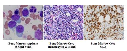 Bone Marrow Aspirate, Core Biopsy and Immunohistochemical Stain